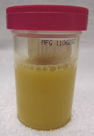 Urine test for chlamydia