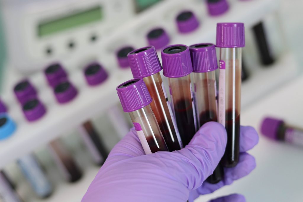 A purple gloved hand holds five vials of blood for hepatitis testing