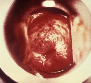 Inflamed "strawberry cervix" caused by the STD trichomoniasis.