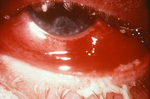 Conjunctivitis due to gonorrhea. Swollen red eye with cloudy discharge