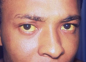 Jaundice Eyes Hep A Jaundice, or yellowing of the whites of the eyes, caused by Hepatitis A