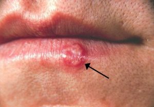 A red, bumpy cold sore on the lower lip from oral herpes | Herpes Testing