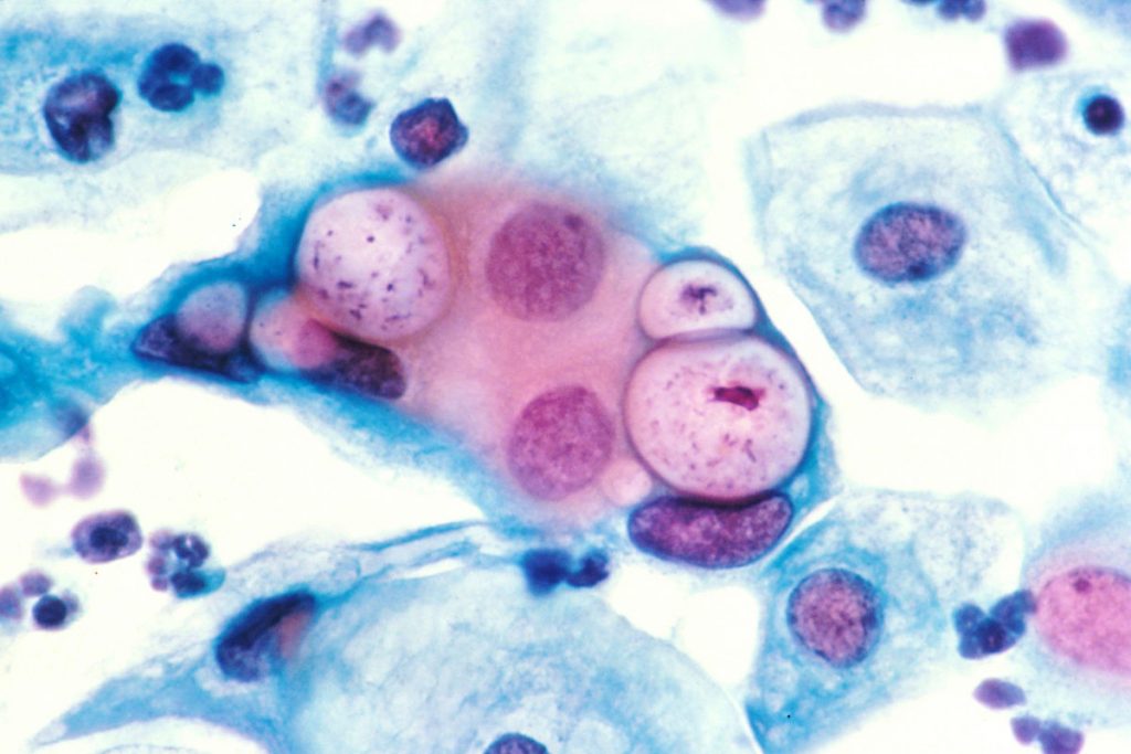 Colorful blue and pink image from a pap smear showing a chlamydia infection.