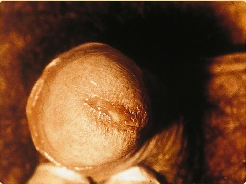 Penile discharge caused by chlamydia.