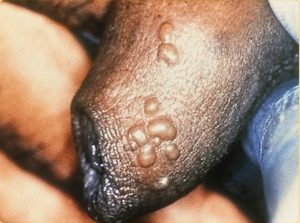 Small outbreak of genital herpes on flaccid penis | Herpes Testing