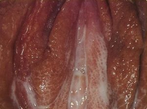 Cloudy gonorrhea discharge from the vagina