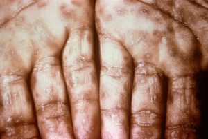 Secondary syphilis rash on the palms of the hand.