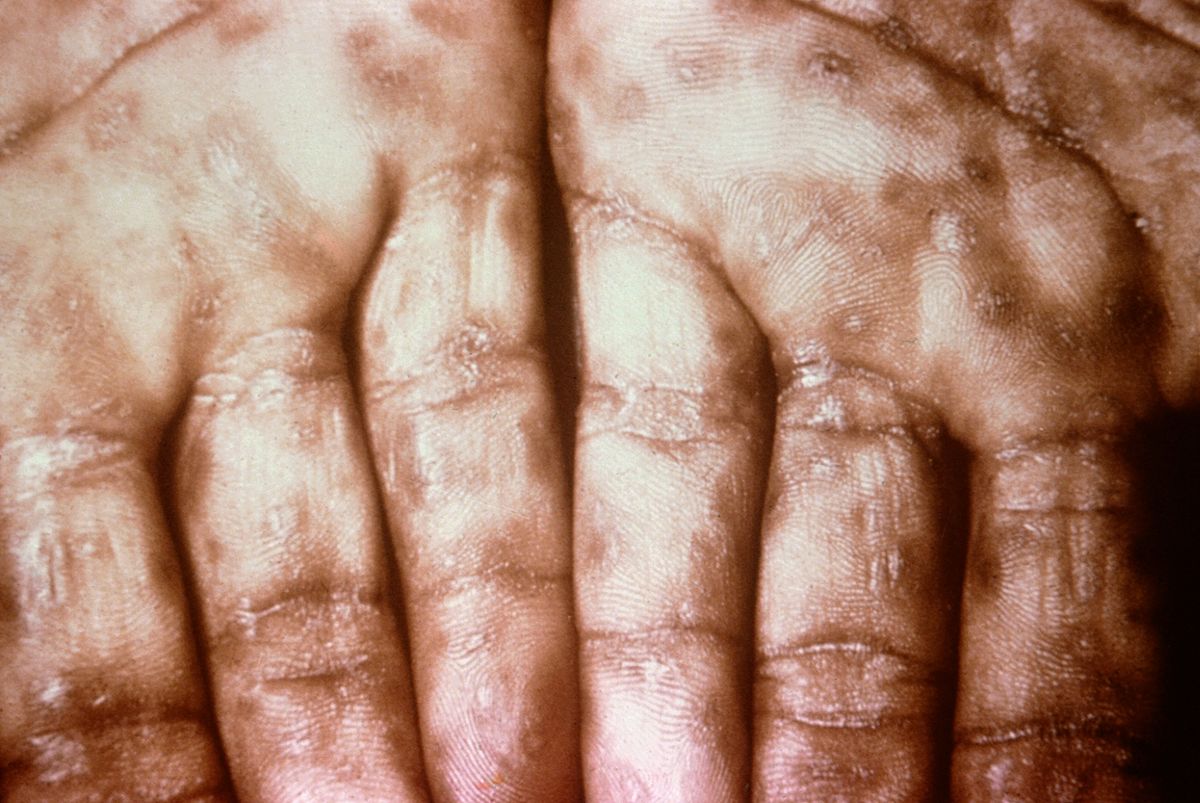 Syphilis Testing Where Can I Get Tested syphilis-testing-where-can-i-get-tested
