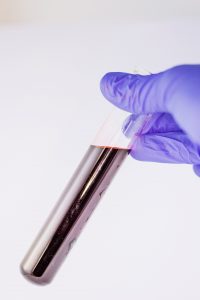 Woman holding vial of blood; blood tests are the most common form of syphilis testing.