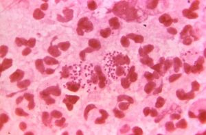 Photomicrograph showing Neisseria gonorrhoeae.