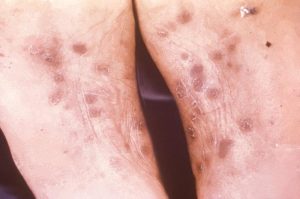 Secondary syphilis rash on feet; looks like small brownish spots